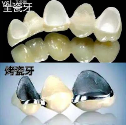 铸瓷牙的价格(铸瓷牙套多少钱一颗)-图2 铸瓷牙的价格(铸瓷牙套多少钱一颗)-图2