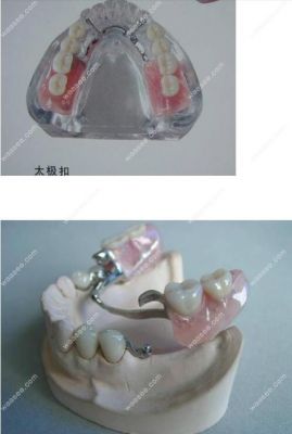 附着体义齿价格(什么叫附着体义齿)-图2 附着体义齿价格(什么叫附着体义齿)-图2