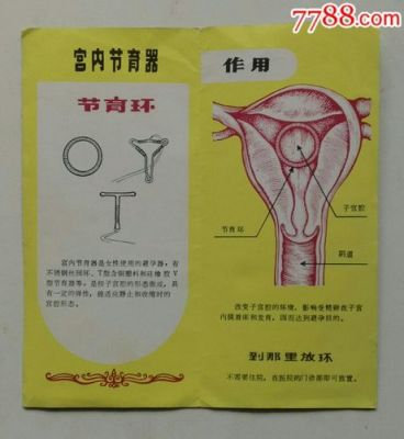 宫内节育器价格(宫内节育器科普)-图2 宫内节育器价格(宫内节育器科普)-图2