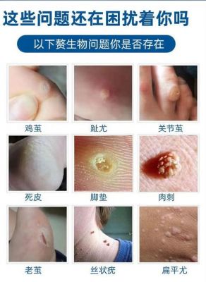 泌疣清价格(疣清一号多少钱)-图3 泌疣清价格(疣清一号多少钱)-图3