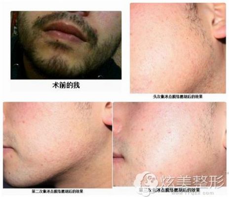 络腮胡价格(络腮胡范围)-图3 络腮胡价格(络腮胡范围)-图3