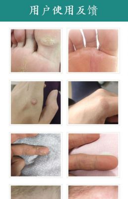 手疣净价格(手疣治疗后完全去除的图片)-图2 手疣净价格(手疣治疗后完全去除的图片)-图2