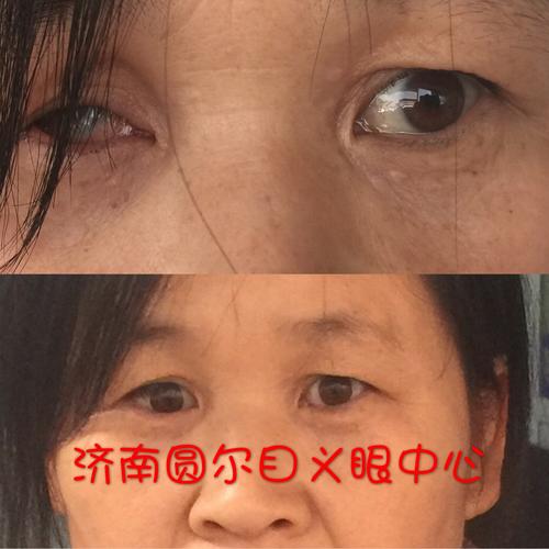 安装义眼价格(安装义眼需要摘除眼球吗)-图1 安装义眼价格(安装义眼需要摘除眼球吗)-图1