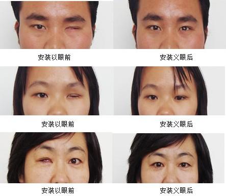 安装义眼价格(安装义眼需要摘除眼球吗)-图2 安装义眼价格(安装义眼需要摘除眼球吗)-图2