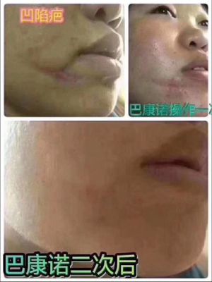 巴康诺价格(巴康诺祛疤效果怎么样)-图2 巴康诺价格(巴康诺祛疤效果怎么样)-图2