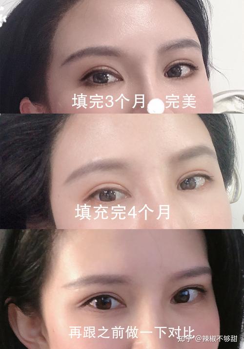隆眉骨价格(隆眉骨前后对比照片)-图2 隆眉骨价格(隆眉骨前后对比照片)-图2