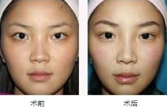 隆眉骨价格(隆眉骨前后对比照片)-图3 隆眉骨价格(隆眉骨前后对比照片)-图3