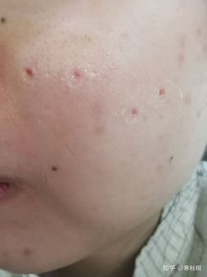 沈阳七院点痦子价格（沈阳七院点痦子多少钱）