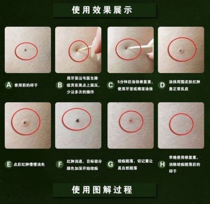 去黑痣价格(祛黑痣多少钱)-图3 去黑痣价格(祛黑痣多少钱)-图3