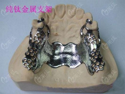 纯钛假牙价格(纯钛假牙支架的价格)-图3 纯钛假牙价格(纯钛假牙支架的价格)-图3