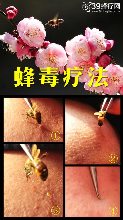 蜂疗的价格（蜂疗价格高吗）