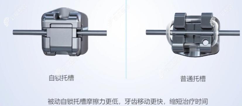 ao自锁托槽价格（自锁托槽的）