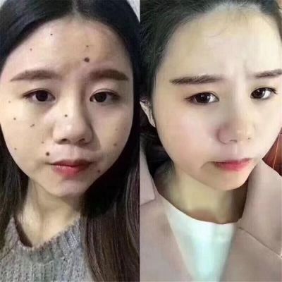 美痣堂祛痣价格(美痣堂祛痣价格多少)-图3 美痣堂祛痣价格(美痣堂祛痣价格多少)-图3