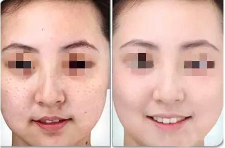 雀斑价格表(雀斑治疗效果怎么样)-图3 雀斑价格表(雀斑治疗效果怎么样)-图3