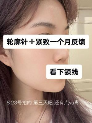 轮廓针价格(轮廓针价格多少)-图2 轮廓针价格(轮廓针价格多少)-图2