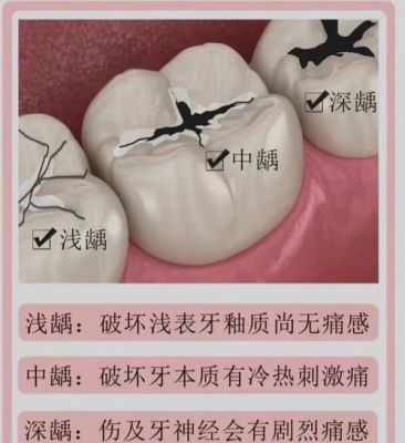 龋洞价格(龋洞修补多少钱)-图1 龋洞价格(龋洞修补多少钱)-图1