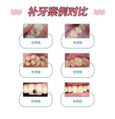 龋洞价格(龋洞修补多少钱)-图2 龋洞价格(龋洞修补多少钱)-图2