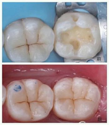 龋洞价格(龋洞修补多少钱)-图3 龋洞价格(龋洞修补多少钱)-图3