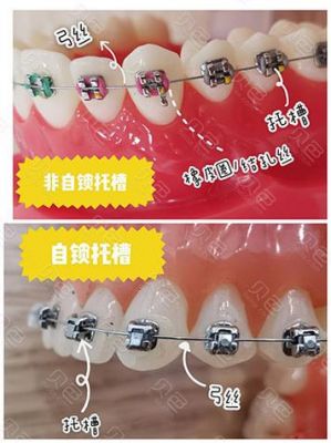 ao自锁托槽价格（自锁托槽使用方法视频）