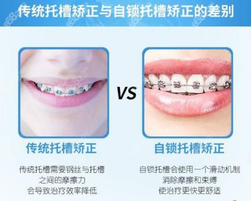 ao自锁托槽价格(自锁托槽使用方法视频)-图2 ao自锁托槽价格(自锁托槽使用方法视频)-图2