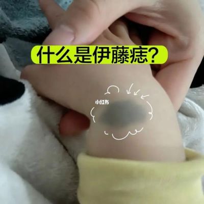 伊藤痣价格（伊藤痣可以根除吗）-图2