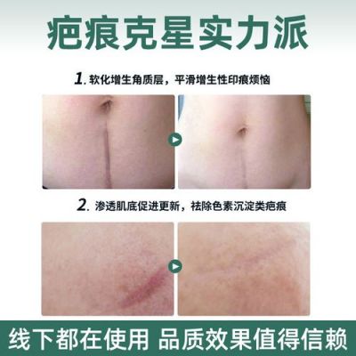 丝芙康价格(丝芙康祛疤效果怎么样)-图3 丝芙康价格(丝芙康祛疤效果怎么样)-图3